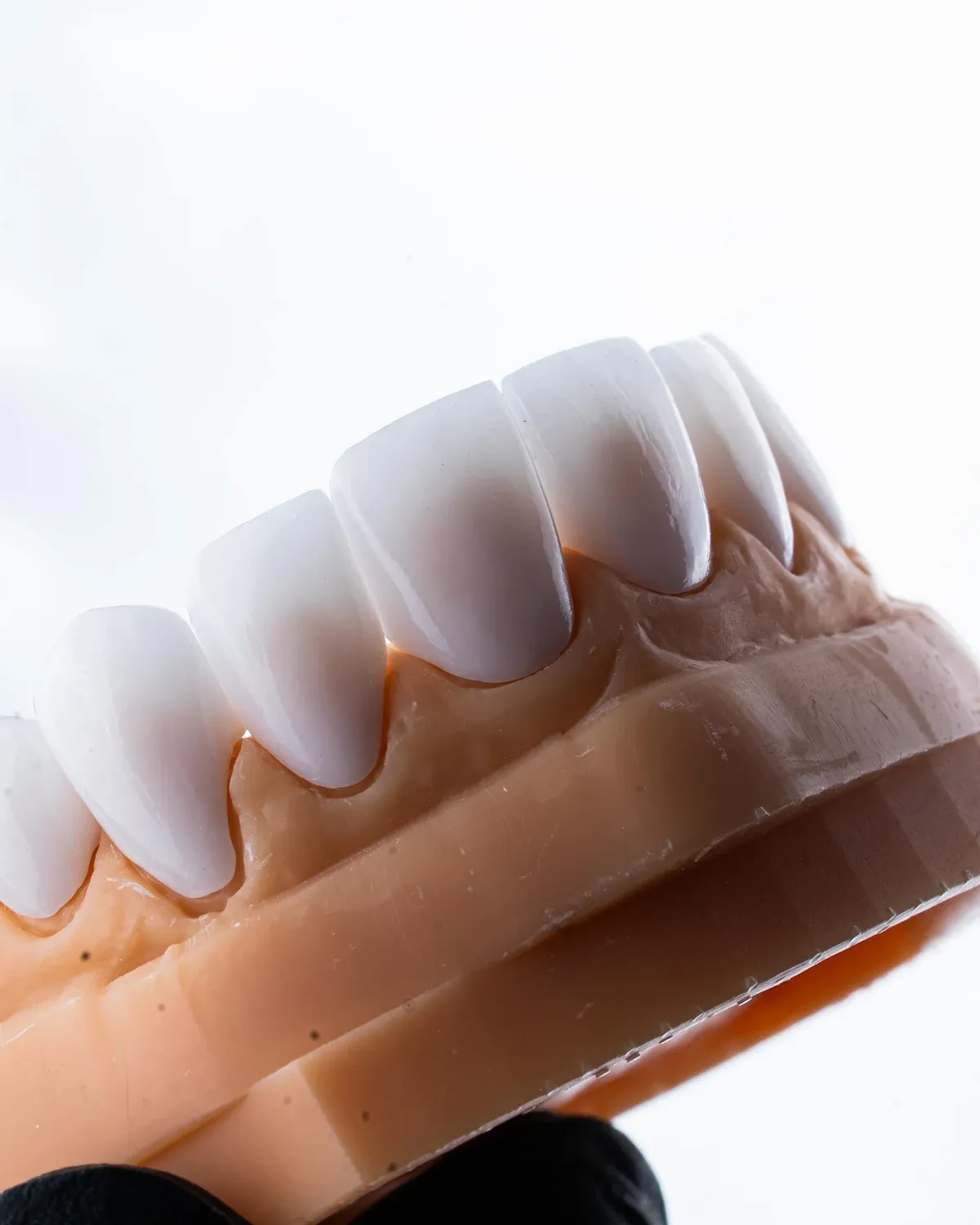 Porcelain veneer shells seated on a dental model, lit against white